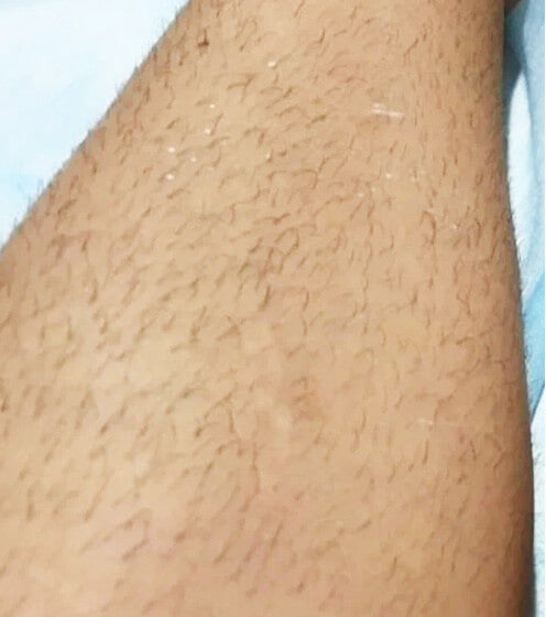 Legs - Before
