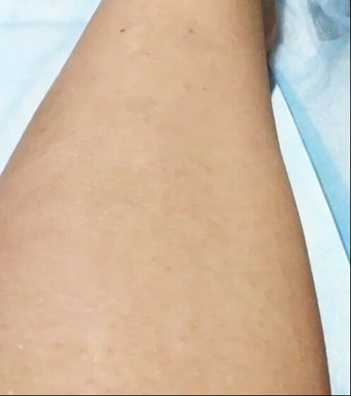 Legs - After