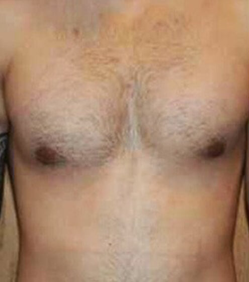 Chest - Before