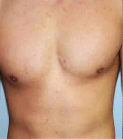 Chest - After