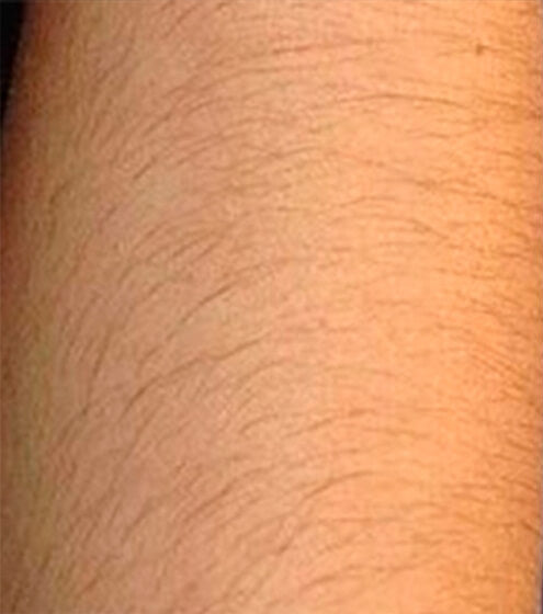 Arms - Before