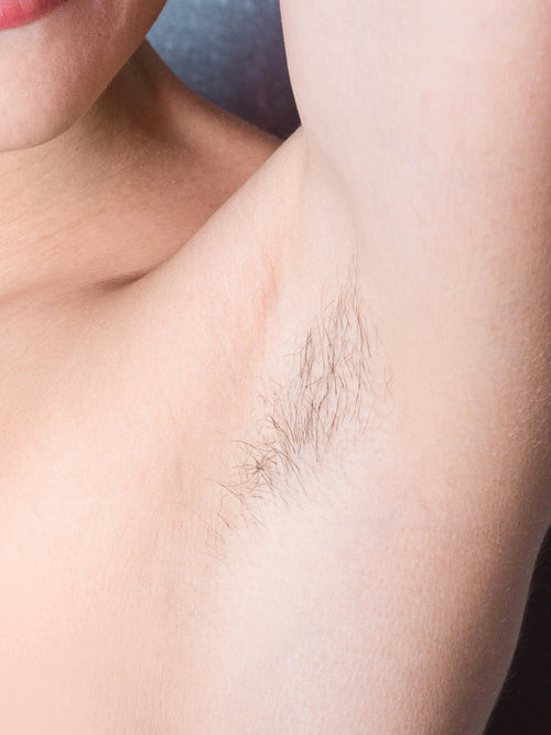 Underarms - Before